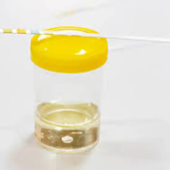 Urea Nitrogen, 24-Hour Urine Test